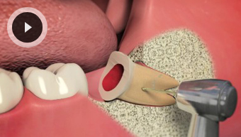 Extractions / Oral Surgery