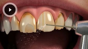 Porcelain Veneers