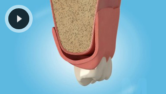 Denture Stabilisation