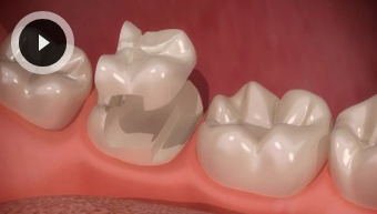 Inlays & Onlays